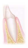 歯周病の進行度　歯肉炎の状態