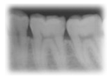 歯周病の進行度　歯肉炎の状態