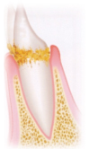 歯周病の進行度　歯石はさらに付
