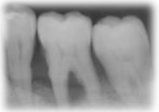 歯周病の進行度　重度の歯周病の状態