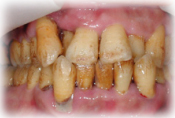 重度の歯周病1