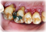 重度の歯周病2