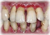重度の歯周病3